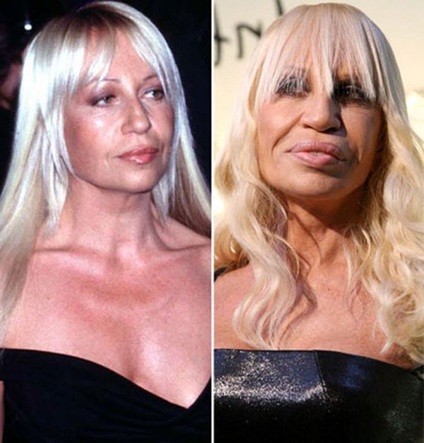 Donatella Versace  Celebrity plastic surgery, Beauty hacks, Plastic  surgery gone wrong