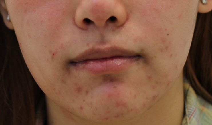 Acne-around-mouth-and-Chin