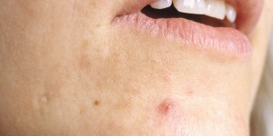 CLOSE UP WOMANS CHIN SHOWING ACNE