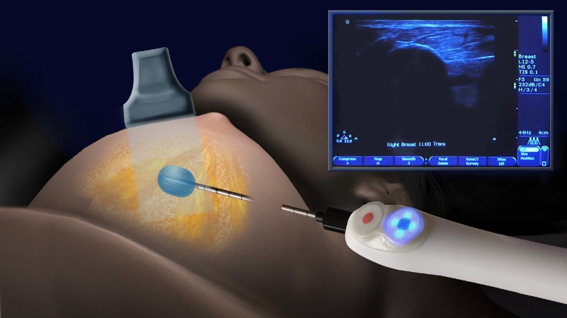 In the ICE3 cryoablation of breast cancer trial, a liquid nitrogen cooled probe is inserted into the tumor under ultrasound guidance. The super cooled probe freezes the water in the cancer cells creating an ice ball (demonstrated with water in photo). The freezing of the tumor cells to very low temperatures causes the cells to crack open and die. The body's immune system absorbs the destroyed cells over time and new tissue takes their place. (PRNewsFoto/IceCure Medical)