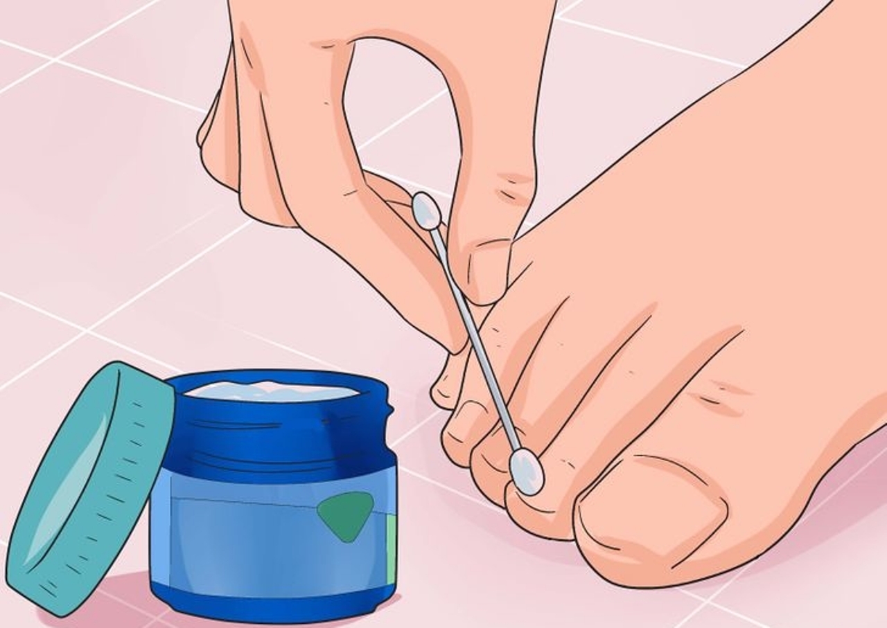 Ingrown Toenail Treatment: Powerful Home Remedies | Footfiles