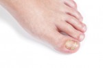 Skin fungus on the nail, on the female foot. Close-up.