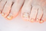 fungal_nail_infection
