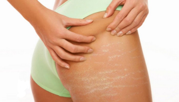 Why Do Stretch Marks Happen? Can We Avoid Them? | Pamper.My