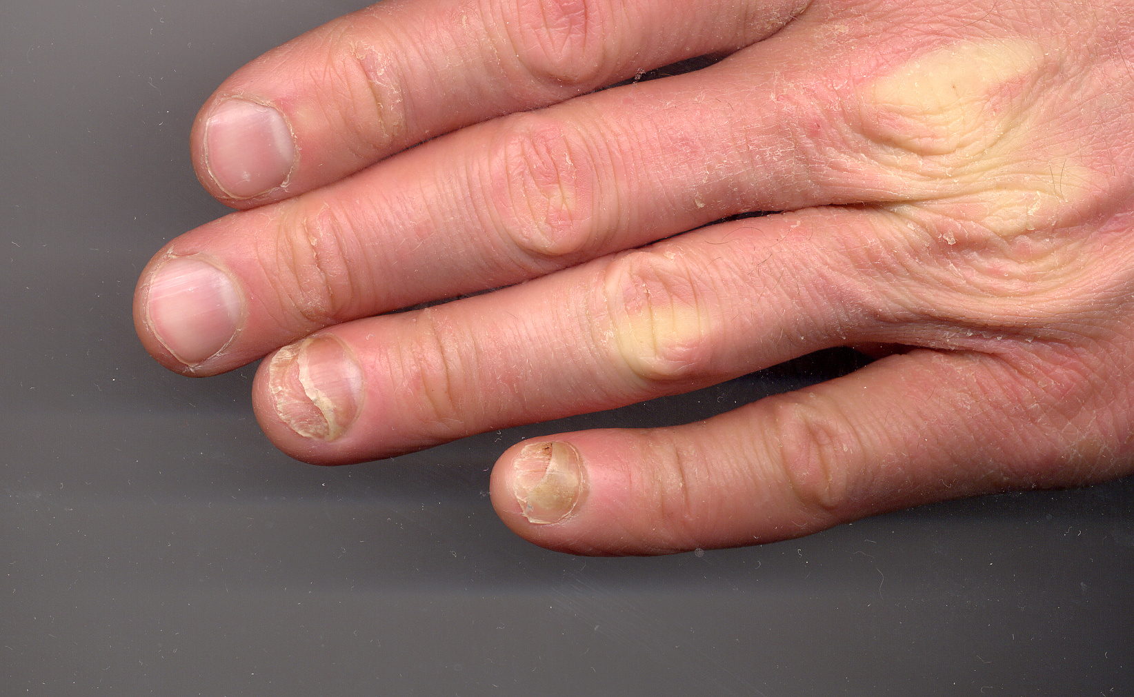 Nail psoriasis