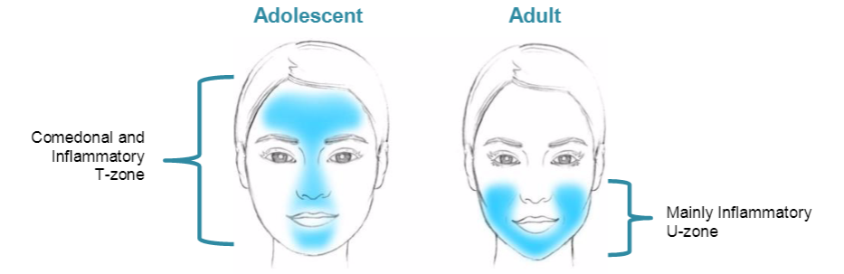 Kiehl's Face Acne charts-Pamper.My