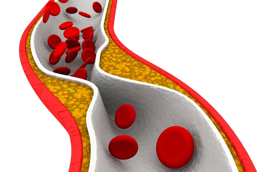 Cholesterol plaque in artery image.
