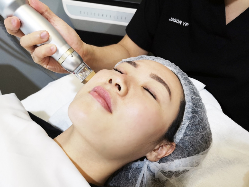 Astute Clinic's Flawless Skin Laser Treatment Uses Sylfirm Technology To Reduce Rosacea & Melasma