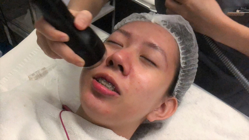 #PamperWithKye: I Tried Cryo Facial For The First Time